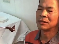 Mimisan 10 Hari Nonstop, Ternyata Ada Lintah Hidup di Hidung