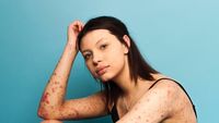 Tubuh Penuh Luka, Model Ini Buktikan Cantik Nggak Harus Berkulit Mulus