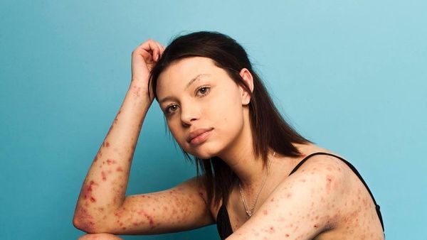 Tubuh Penuh Luka, Model Ini Buktikan Cantik Nggak Harus Berkulit Mulus