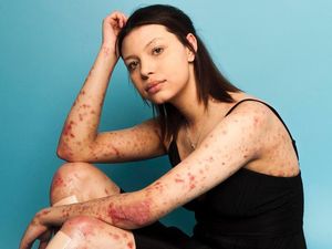 Tubuh Penuh Luka, Model Ini Buktikan Cantik Nggak Harus Berkulit Mulus