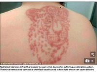 Kisah Kakak-Adik yang Kulitnya Melepuh Setelah Pakai Tato Henna