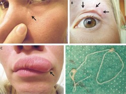 Benjolan Misterius di Wajah Wanita Cantik Ini Ternyata Cacing Parasit