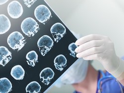 Epilepsi, Kenali Gejala hingga Pengobatannya