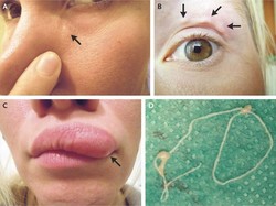 Wajah Wanita Ini Bengkak Secara Misterius, Ternyata Ada Cacingnya