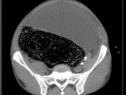 Kaki Mati Rasa, Ternyata Ada 2 Liter Feses di Perut Pria Ini