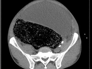Kaki Mati Rasa, Ternyata Ada 2 Liter Feses di Perut Pria Ini Kaki Mati Rasa, Ternyata Ada 2 Liter Feses di Perut Pria Ini