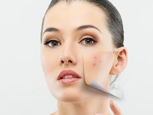 Saran Psikolog Buat Wanita yang Jerawatan Parah Sampai Stres Saran Psikolog Buat Wanita yang Jerawatan Parah Sampai Stres