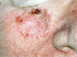 Kanker Kulit: Penyebab, Gejala, Jenis, hingga Ciri-cirinya