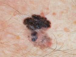 Awalnya Hanya Bintik Kecil, Ternyata Kanker Kulit Merusak Kepala Pria Ini