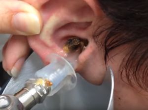 Hiii! Begini Penampakan Kotoran Telinga Manusia yang Menumpuk