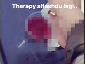 Ikut Terapi Al-Fashdu, Darah Mancur dari Kaki Maia Estianty