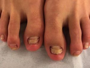 Kejadian Langka Kuku Nyaris Copot Gara-gara Coba Spa Ikan