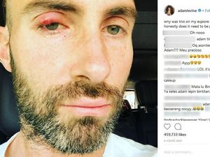 Adam Levine Bintitan, Masih Ganteng Nggak? Adam Levine Bintitan, Masih Ganteng Nggak?
