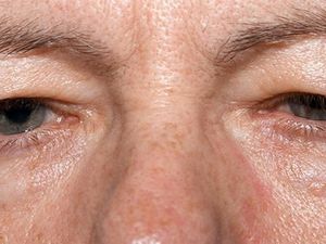 Kisah Pria yang Wajahnya Berlubang Akibat Kanker Ganas