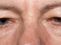 Kisah Pria yang Wajahnya Berlubang Akibat Kanker Ganas