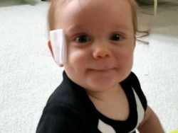 Cerita Bayi yang Wajahnya Terluka Gara-gara Empeng