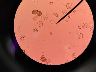 Cantik Tapi Mengerikan, Kristal Asam Urat di Bawah Lensa Mikroskop