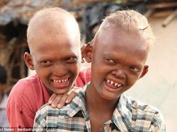 Kisah Haru Kakak Beradik Dijuluki Anak Setan, Ternyata Idap Penyakit Langka