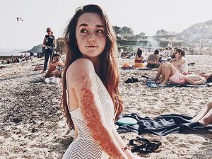 Idap Psoriasis, Wanita Cantik Ini Pede Meski Banyak Bintik di Kulitnya