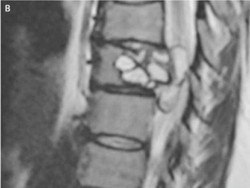 Sering Kesemutan, Ternyata Gara-Gara Cacing Pita di Tulang Belakang