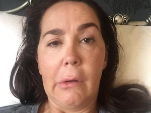 Gara-gara Botox, Wajah Wanita Ini Jadi Mencong