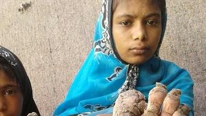 4 Bersaudara yang Tangan Kakinya Membatu Akibat Penyakit Langka