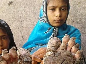 4 Bersaudara yang Tangan Kakinya Membatu Akibat Penyakit Langka