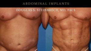 Penampakan Perut Sixpack Hasil Implan, Lebih Menarik dari yang Asli?