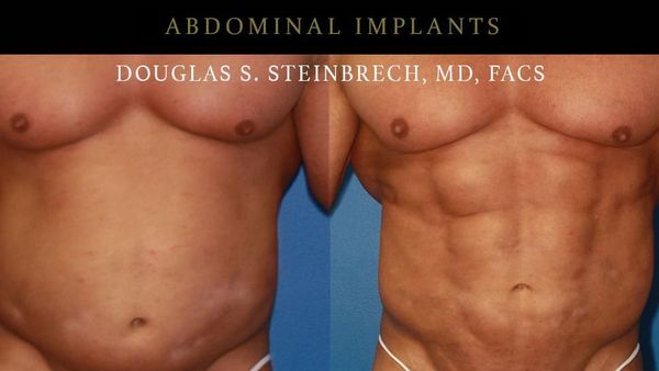 Penampakan Perut Sixpack Hasil Implan, Lebih Menarik dari yang Asli?