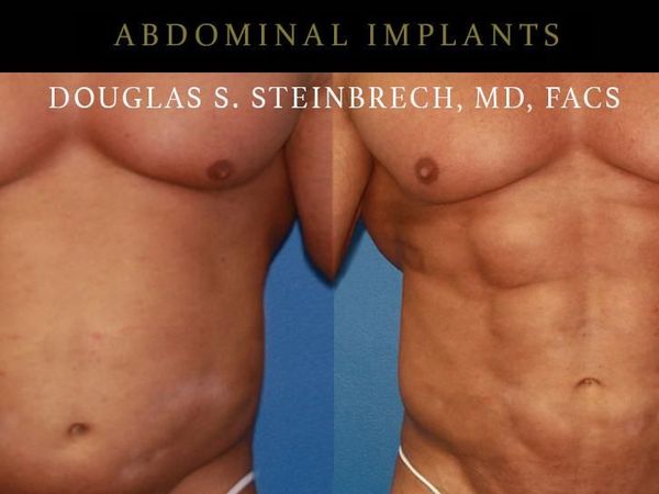 Penampakan Perut Sixpack Hasil Implan, Lebih Menarik dari yang Asli?