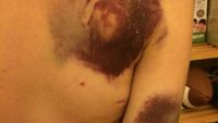 Foto: Contoh Memar dan Ruam yang Bisa Jadi Tanda Kanker Darah Leukemia
