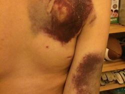 Foto: Contoh Memar dan Ruam yang Bisa Jadi Tanda Kanker Darah Leukemia