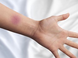 Bukan Alasan Mistis, Ini Alasan Badanmu Mudah Memar