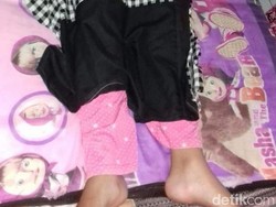 Begini Kondisi Siswi yang Lumpuh Akibat Dihukum Squat Jump