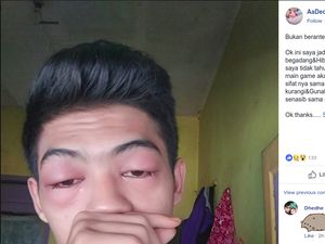 Kata Dokter Soal Mata Bengkak Karena Keasyikan ML