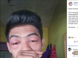 Kata Dokter Soal Mata Bengkak Karena Keasyikan ML