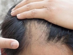 Peneliti Terkejut, Ada Metode yang Cepat Menumbuhkan Rambut