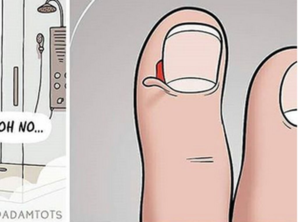 Foto: Ilustrasi Kulit Samping Kuku Terkelupas yang Bikin Ngilu Foto: Ilustrasi Kulit Samping Kuku Terkelupas yang Bikin Ngilu