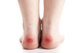 Kena Getah Beracun Ubi Liar, Kaki Wanita Ini Melepuh