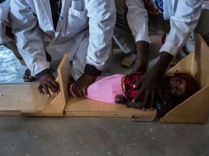 Potret Miris Anak-anak Malnutrisi dan Stunting di Seluruh Dunia