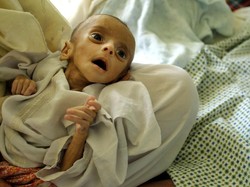 Marasmus: Penyebab, Gejala, Komplikasi, dan Pengobatannya