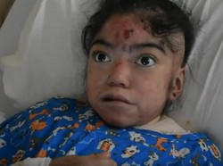 Penyakit Langka Bikin Tubuh Wanita Ini Seperti Terbakar