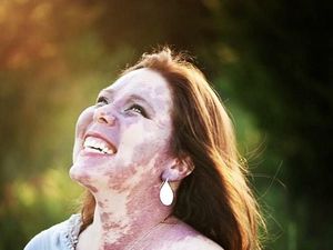 Inspiratif! Ini Kisah Dramatis Wanita yang Punya Tanda Lahir Sewajah