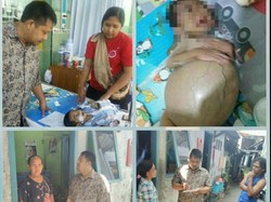 Ardan, Bayi Atresia Bilier yang Viral karena Butuh Cangkok Hati