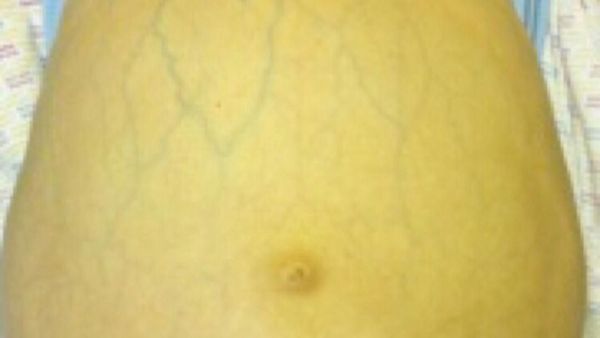 5 Gejala Hepatitis dalam Gambar