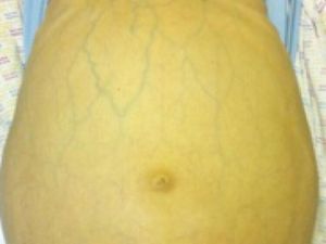 5 Gejala Hepatitis dalam Gambar