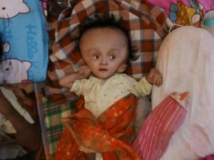 Tolong! Balita di Jeneponto Ini Kena Hidrosefalus