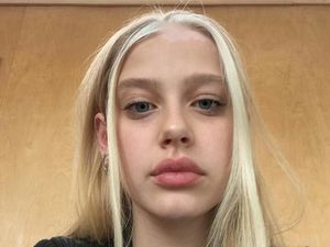 Foto: Rambut Wanita Ini Terlihat Keren, Ternyata Alami Kelainan Genetik