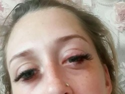 Gara-gara Extension Bulu Mata Jelang Lahiran, Wanita Ini Nyaris Buta