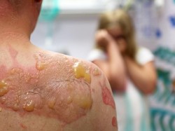 Bergurau dengan Hot Water Challenge, Sekujur Tubuh Bocah Ini Melepuh